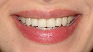 IMAGE2_Ortodontia-Lingual